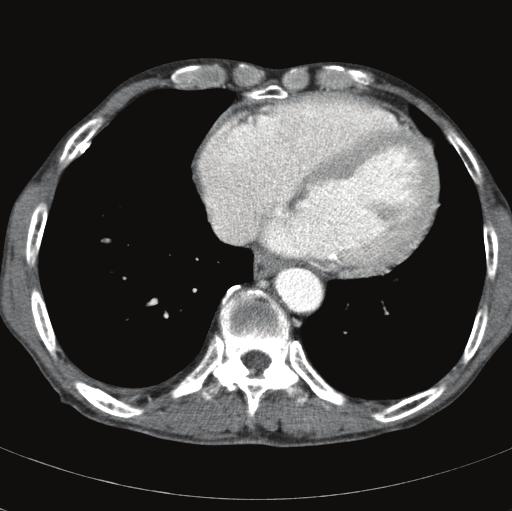 fter pericardiocentesis, chest CT scan showed no pericardial effusion ().