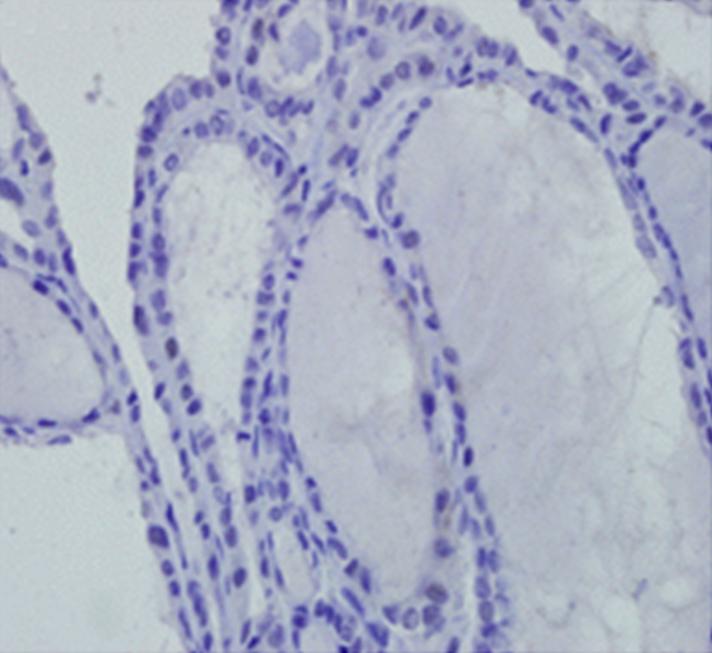 582 Lymph node metastasis P=1.0 P=0.234 Perithyroidal soft tissue invasion Tumor size P=1.