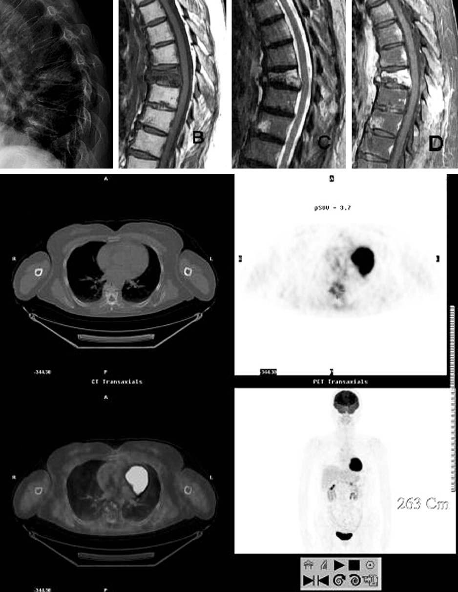 척추병적골절에서 PET 의유용성 전창훈외 결 과 2. F-18 FDG-PET 의판정분석 (Table. 2) 1. MRI 판독분석 최종진단 18 례의단순압박골절중에서 MRI 는 15 례를진양성 (true positive) 으로판독하였고, 최종진단 11 례의병적골절중에서 9 례를판독하였다. 단순압박골절진단에대해 83.3% 의민감도와 81.