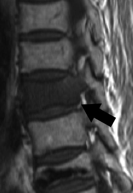 There is an acute compression fracture of T12 on the fat-suppressed T2 weighted sagittal MR images (arrow). B.