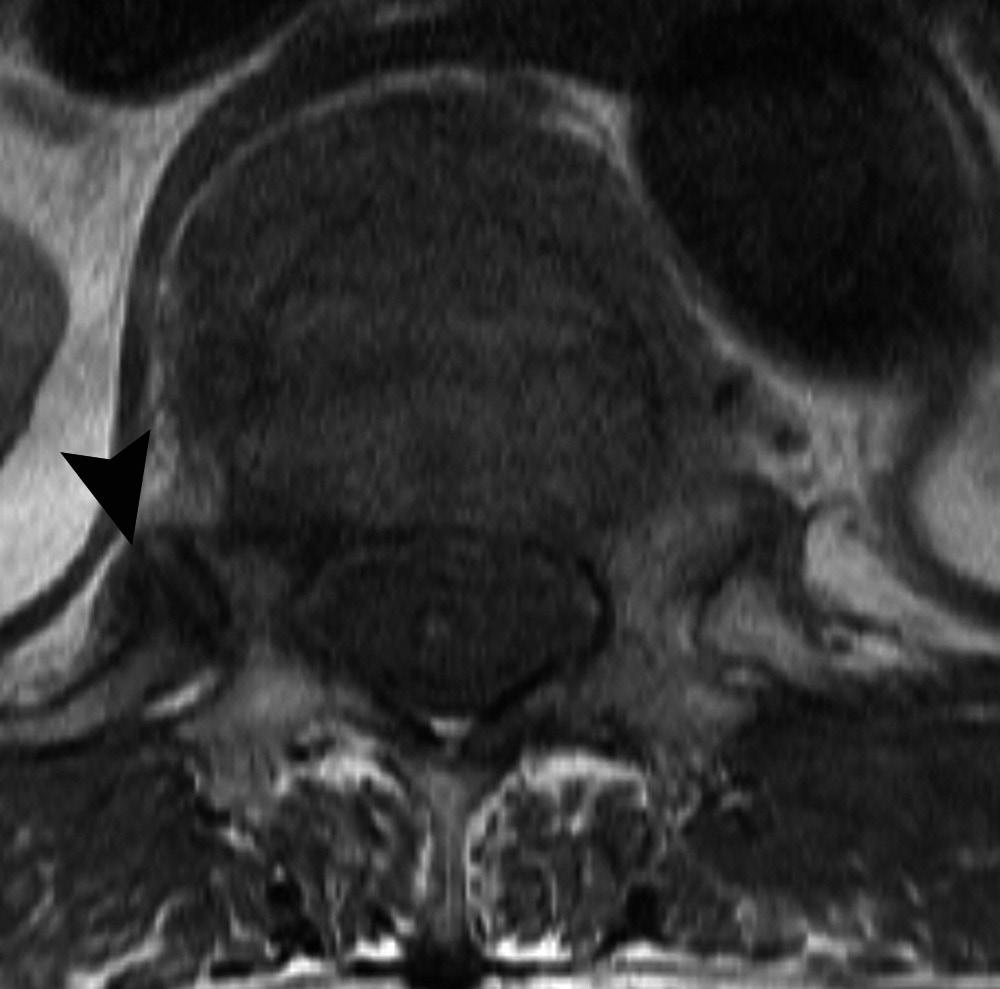The lesion shows no uptake on the bone scan (not shown). Note.-MR = magnetic resonance, SI = signal intensity, T1W = T1 weighted A B Fig. 4. A 63-year-old female patient who had low back pain.