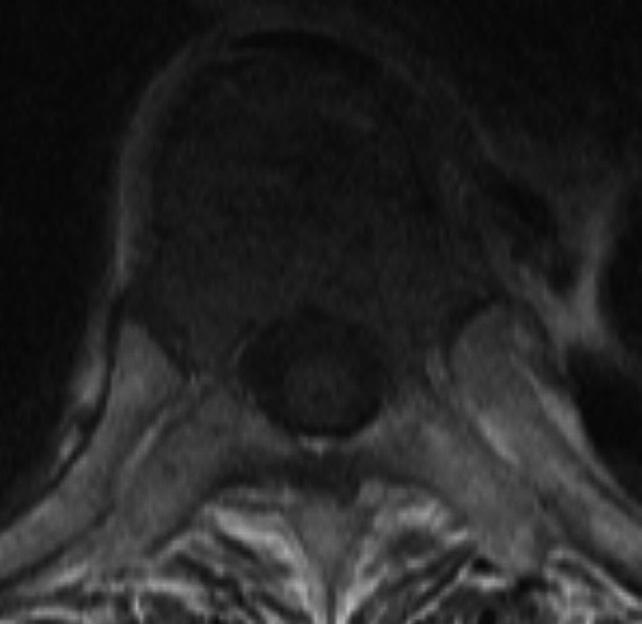 On T1 and fat-suppressed T2 weighted sagittal MR images, the height of T9 vertebral body is decreased and the bone marrow SI of the body has diffusely changed, which suggests the acute compression