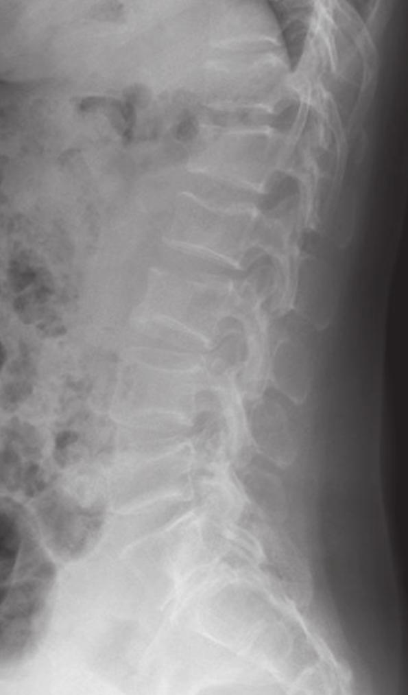 2007 년갑상선결절을진단받았으 나추가검사를진행하지않았다. A Fig. 1. Thoracolumbar (T-L) spine lateral and lumbar (L) spine lateral plain films show multiple compression fractures at through. B 가족력 : 어머니가골다공증으로투약중이다.