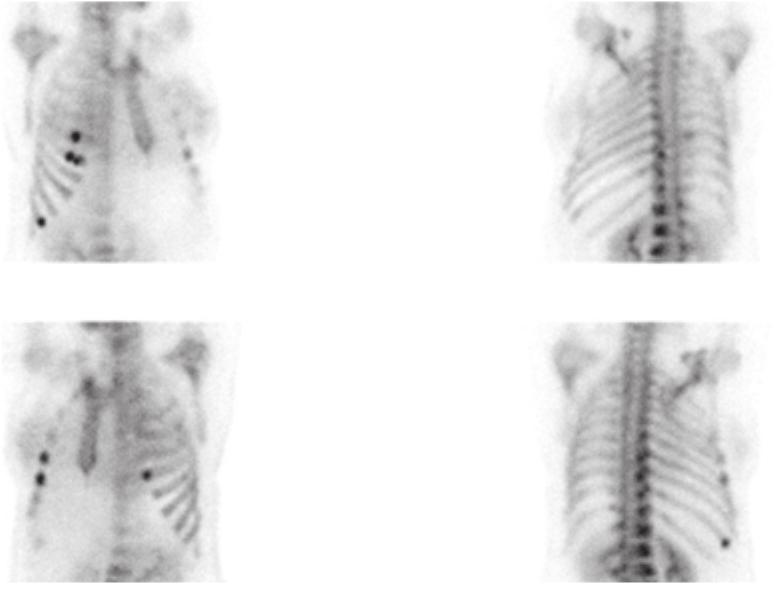 흉부전산화단층촬영에서우측 6번째늑골에골절이, 그리고좌측 8번째늑골에피질골팽창소견이관찰되었으나, 악성종양을시사하는소견은보이지않았다. 복부컴퓨터단층촬영에서도악성종양을시사하는소견은관찰되지않았다. 골밀도검사결과, 요추 1번 Z-score는 -3.6이었으며, 좌측대퇴부경부 Z-score -3.