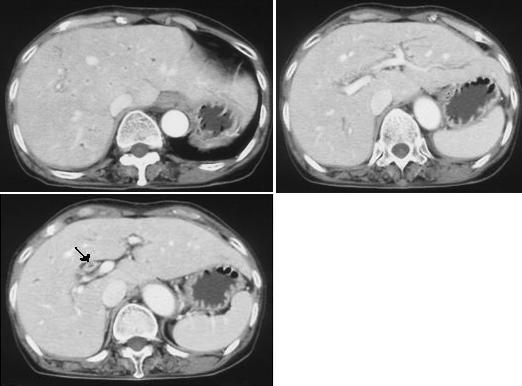 - 대한내과학회지 : 제 70 권부록 2 호 2006 - A B C Figure 1. (A, B) Abdominal CT scan shows slightly dilated intrahepatic biliary tree. (C) Abdominal CT scan shows thickened wall of common hepatic duct.