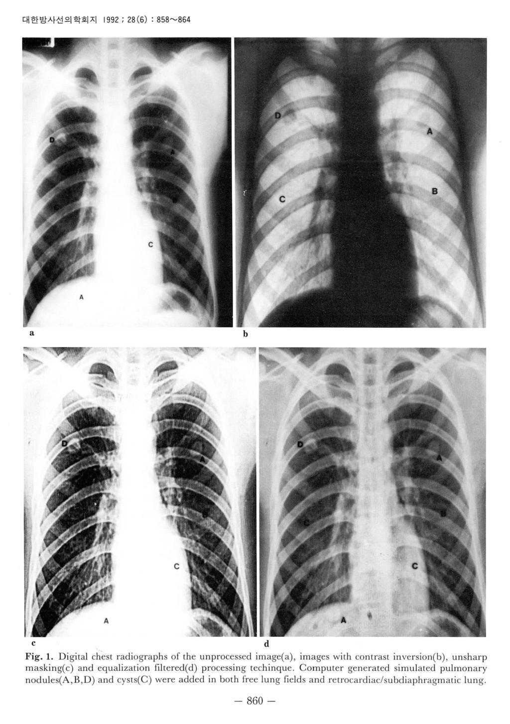 대한방사선의학회지 1992 ; 28 (6) : 858~864 a b c d Fig. 1. Digital chest radiographs of the unprocessed image(a), images with contrast inversion(b), unsharp masking(c) and equalization filtered(d) processing techinque.