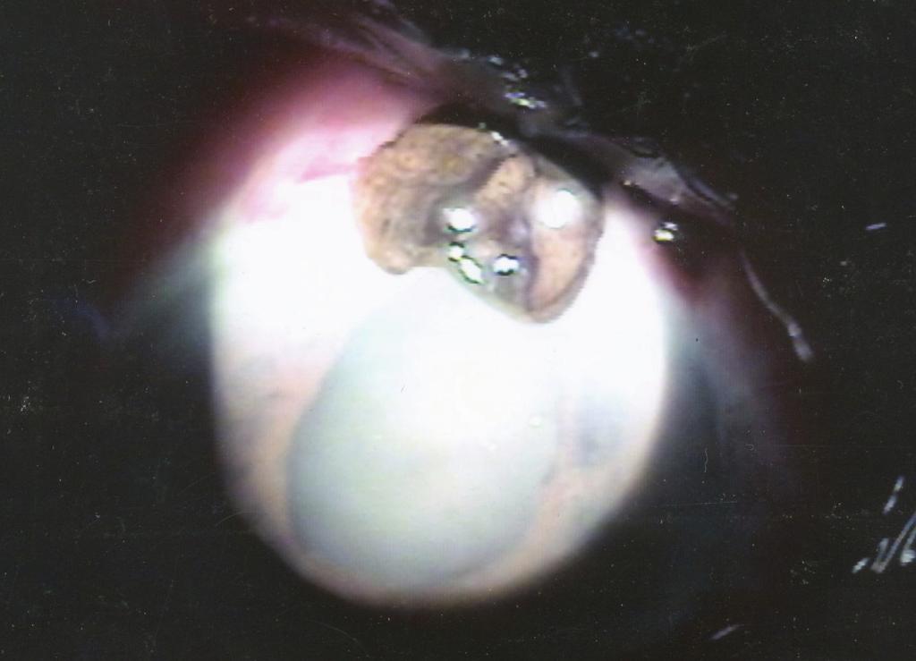 대한안과학회지 2008 년제 49 권제 10 호 Figure 1. Preoperative anterior segment photograph of the right eye.
