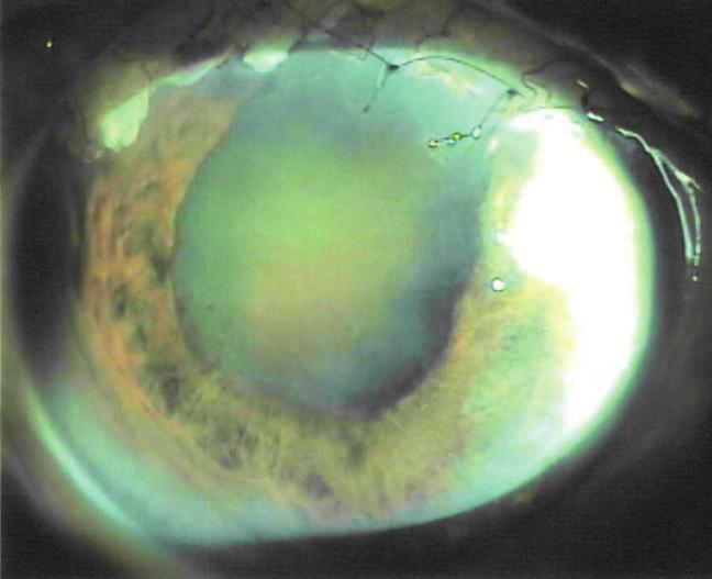 (B) Anterior segment photograph 3 months after phacoemulsification and IOL implantation in the bag.