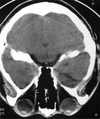Five years after initial diagnosis, the size of cyst was markedly increased(c, D).