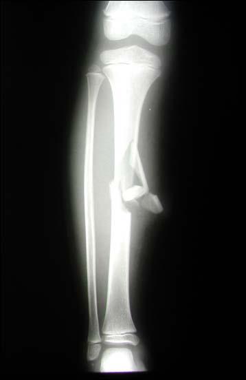 A B C D Figur e 1. A 14-year-old girl with a cavus foot deformity after open type IIIA tibia fracture.