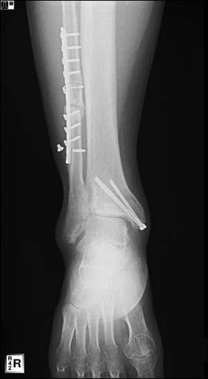김정렬 김영신 신성진 김상림 서규범 A B C Figur e 2. A 28-year-old man with a checkrein deformity. (A) Pre- operative radiograph showing a ankle f racture with Tscherne grade 3.