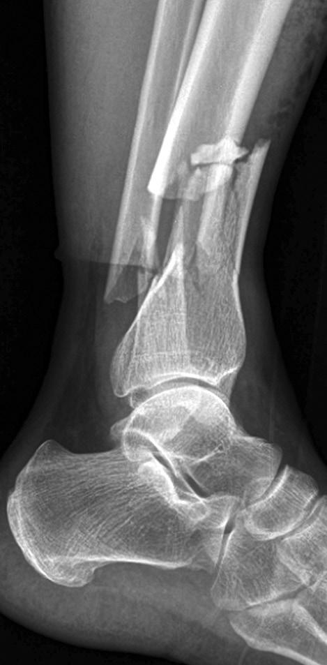 fracture with medial open wound.
