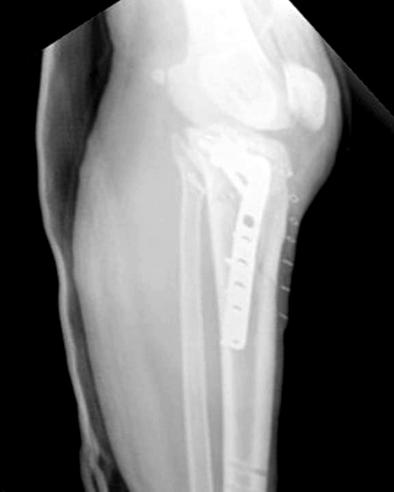 (F, G) Internal fixation was performed after 17 days, and these radiographs shows firm fixation with a lateral