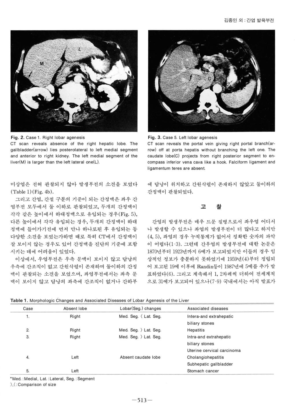 김종민외 간엽발육부전 Fig. 2. Case 1. Right lobar agenesis Fig. 3. Case 5. Left lobar agenesis CT scan reveals absence 01 the right hepatic lobe.