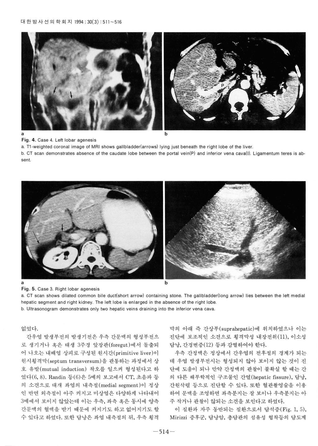 대한방사선으 학회지 1994 : 30( 3) : 511-516 a Fig. 4. Case 4. Left lobar agenesis a. T1 -weighted coronal image 01 MRI shows gallbladder(arrows) Iying just beneath the right lobe 01 the liver b a b Fig. 5. Case 3.