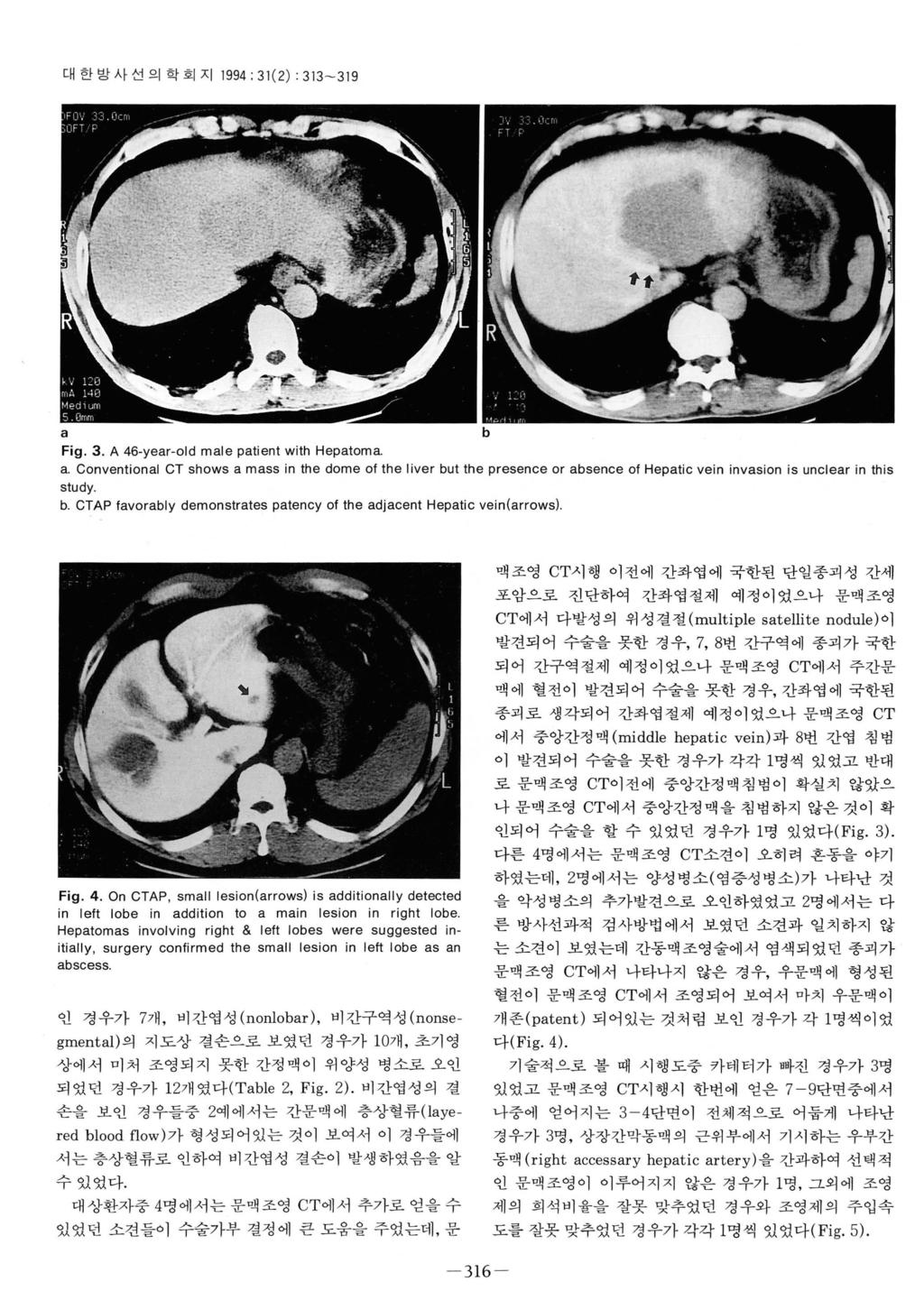 - 316 - 대한밤사선의학회지 1994 : 31(2) : 313-319 Fig. 3. A 46-yer-old mle ptient with Heptom.