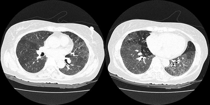 Chest X-ray on admission shows ground glass opacities in both lungs with decreased lung volume. 다. 검사실소견 : 전체혈구계산에서혈색소 14.3 g/dl, 백혈구 10,800/mm 2 ( 중성구 72.5%, 림프구 20.4%, 호산구 2.