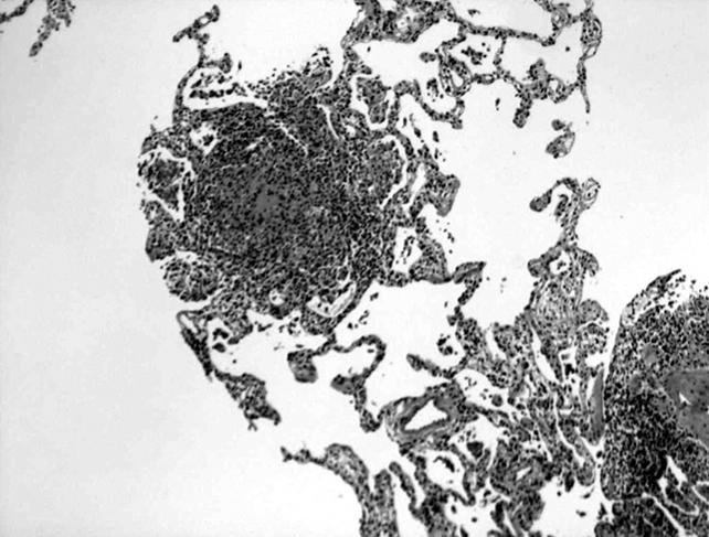 Tuberculosis and Respiratory Diseases Vol. 66. No. 1, Jan. 2009 Figure 3. Left lung flouro-guided biopsy.