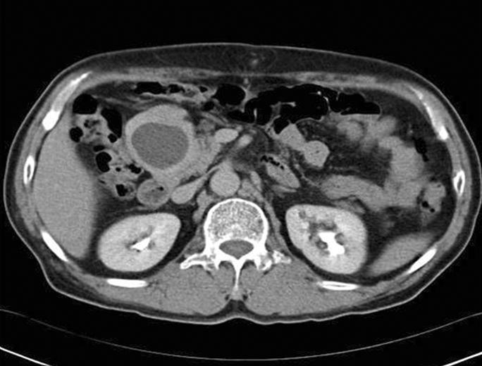 췌장두부의악성종양을의심하여수술하였다. 6 5 3.5 cm 크기의단단한난원형종괴가후복막강에서발견되었고, Fig. 1. Abdominal sonography. It shows a round ball-shaped mass which is 5 cm in diameter near pancreas.