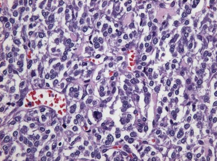 조직검사에서피막을가진낭성종괴가있고, 확대하였을때풍부한미세과립상세포질을가진다형태의세포들이특징적인군집 (Zellballen pattern) 을이루면서비전형적인세포분열은없어신경내분비종양이의심되었다 (Fig. 4A).