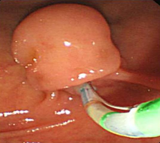 - 대한내과학회지 : 제 86 권제 6 호통권제 646 호 2014 - A B Figure 4. (A) An endoscopic sphincterotomy was performed.