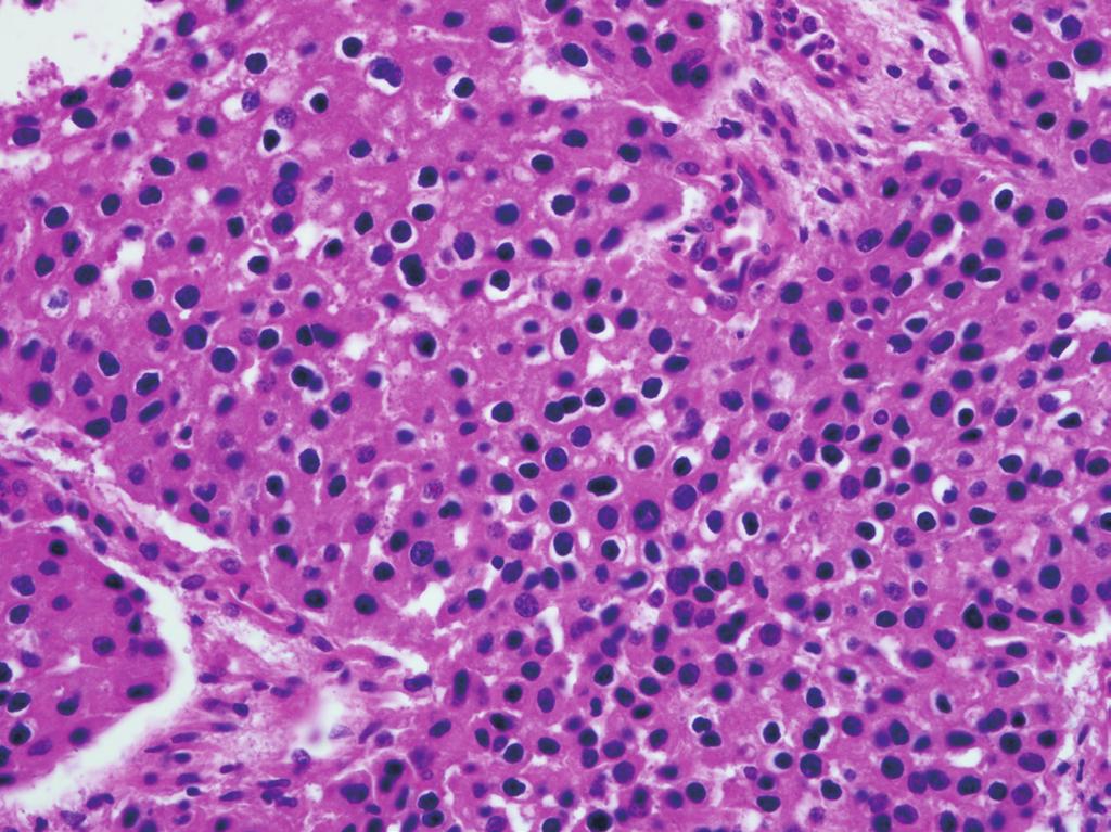 Parathyroid Carcinoma Treatment Using IOPTH ssay 95 Fig. 4. The tumor cells with pleomorphic nuclei are surrounded by vascular structures, and forming trabecular appearance (H&E staining, 400) ().
