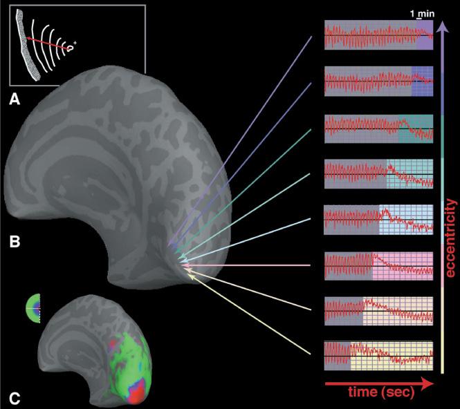 편두통의기능적뇌영상 Figure 2. Spreading suppression of cortical activation during migraine aura.