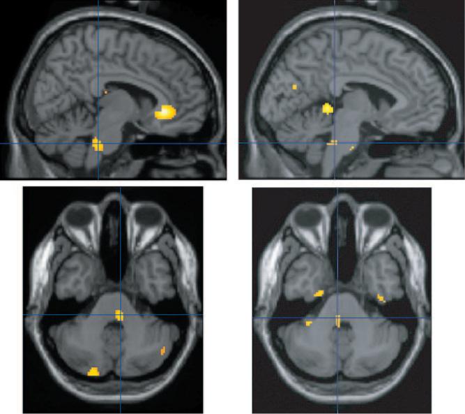 Figure 3. Activation of the ipsilateral pons in patients with right-sided attacks (n= 8, left panel) and left-sided attacks (n=8, right panel).