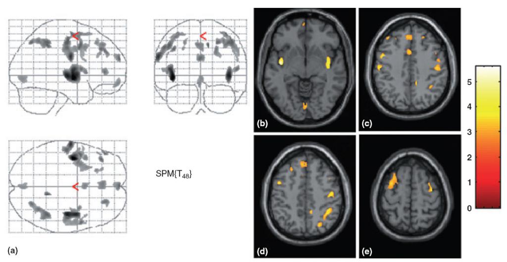 Statistical parametric maps (SPM) demonstrating regional differences in grey matter volume (GMV) between 20 migraine patients and 33 controls.