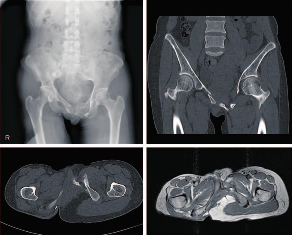 Se-Won Lee et al. Dyspareunia Caused by Pelvis Malunion C Fig. 3. () fter 6 years of operation.