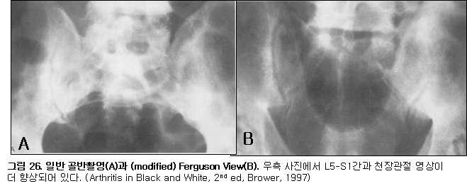 강직성 척추염(Ankyosing spondyitis): 1. 초기.