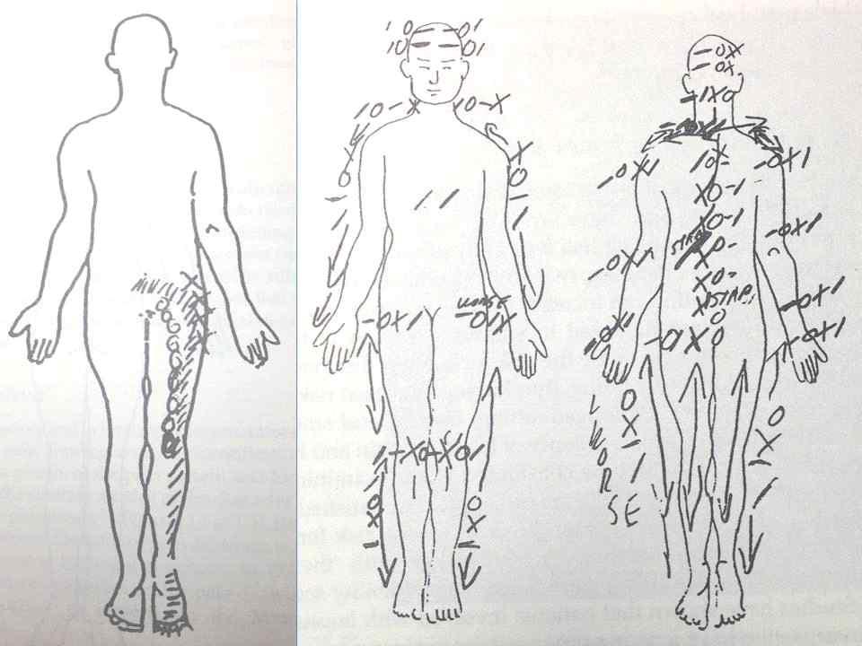 요통의주요질환별전형적증상모식도.