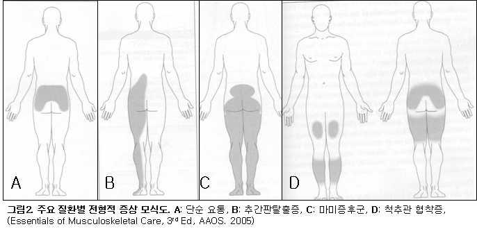 신경근압박을동반한추간판탈출증, C: 마미증후군, D: