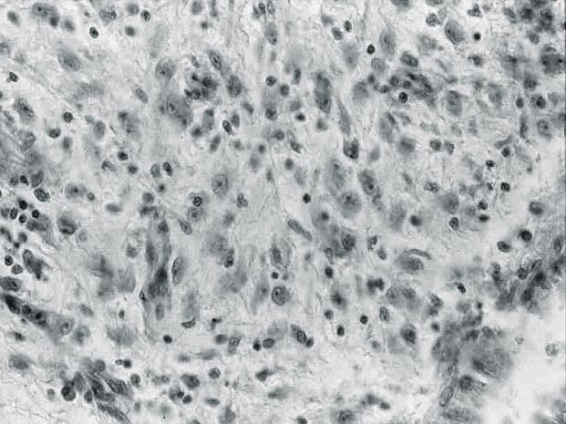 최영민 외 증상이 있는 간의 염증성 근육 섬유 모세포 종 1예 269 ꠏꠏꠏꠏꠏꠏꠏꠏꠏꠏꠏꠏꠏꠏꠏꠏꠏꠏꠏꠏꠏꠏꠏꠏꠏꠏꠏꠏꠏꠏꠏꠏꠏꠏꠏꠏꠏꠏꠏꠏꠏꠏꠏꠏꠏꠏꠏꠏꠏꠏꠏꠏꠏꠏꠏꠏꠏꠏꠏꠏꠏꠏꠏꠏꠏꠏꠏꠏꠏꠏꠏꠏꠏꠏꠏꠏꠏꠏꠏꠏꠏꠏꠏꠏꠏꠏꠏꠏꠏꠏꠏꠏꠏꠏꠏꠏꠏꠏꠏꠏꠏꠏꠏꠏꠏꠏꠏꠏꠏꠏꠏꠏꠏꠏꠏ c d Fig. 5.