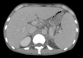 hepatosplenomegaly with no intrahepatic masses.