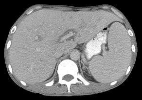 as hepatosplenic T-cell lymphoma are seen in both hepatic lobes.