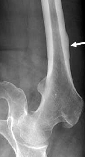 적응증골절부의강력한변형력을감안하여적극적인수술적치료가권장되며골수정을포함한골수내고정방법과활강압박고나사 (dynamic hip screw), 역동적과상나사 (dynamic condylar screw), 대퇴근위부잠김금속판 (proximal femur locking plate), 이분굴곡날금속판