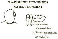 Precision attachment 를이용한국소의치의설계 대부분의국소의치 attachment는 intracoronal attachment와 extracoronal attachment로대별할수있다. 1.