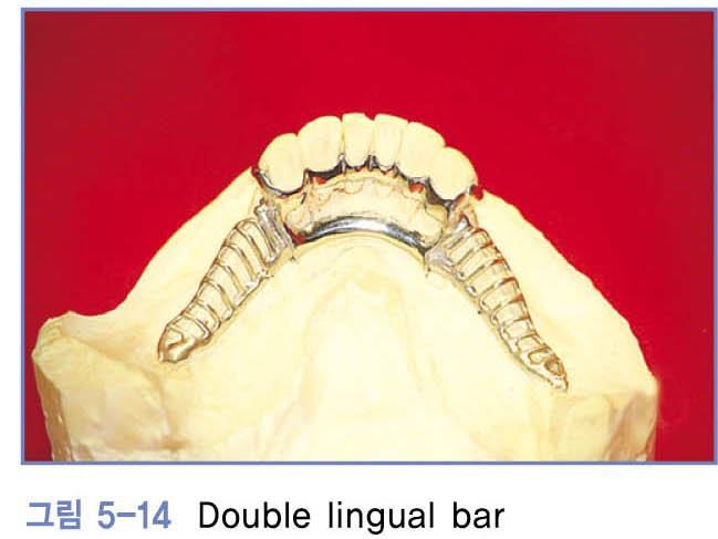 Double Lingual bar - 치아와치아사이의공간이많은경우 -> linguoplate 사용불가 1) 적응증 - wide