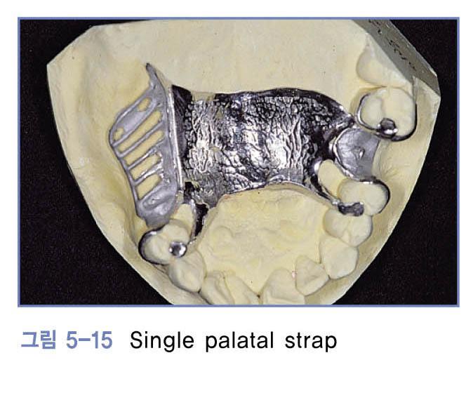 Single palatal strap(bar) - 구개를가로지르는넓고얇은금속대 1) 적응증 a. 대부분의상악국소의치에사용가능 b.