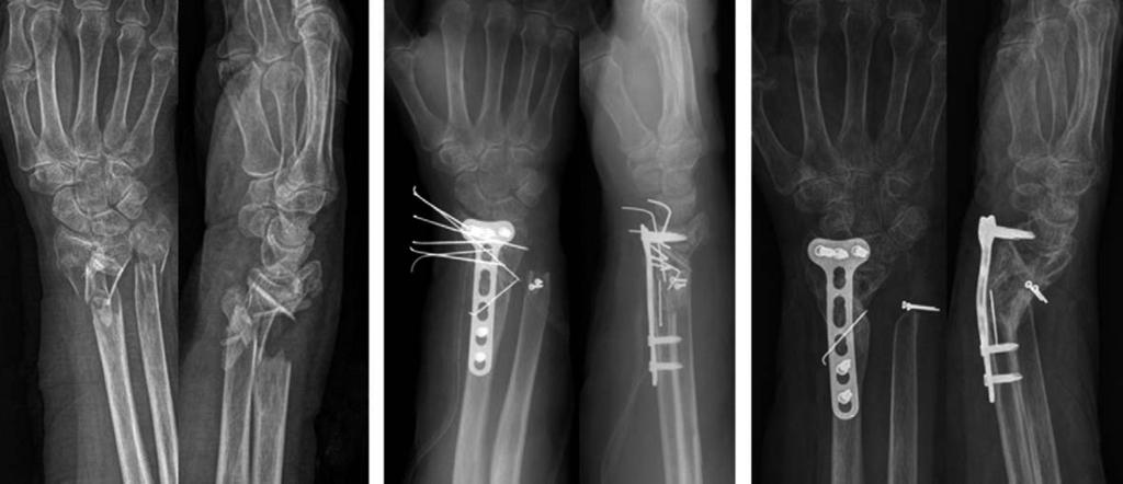 6. Preoperative (A), postoperative (B) and 1-year follow-up (C) radiographs of the wrist of 78-year-old female patient with AO type C2 fracture of the distal radius and Biyani type 4 fracture of the