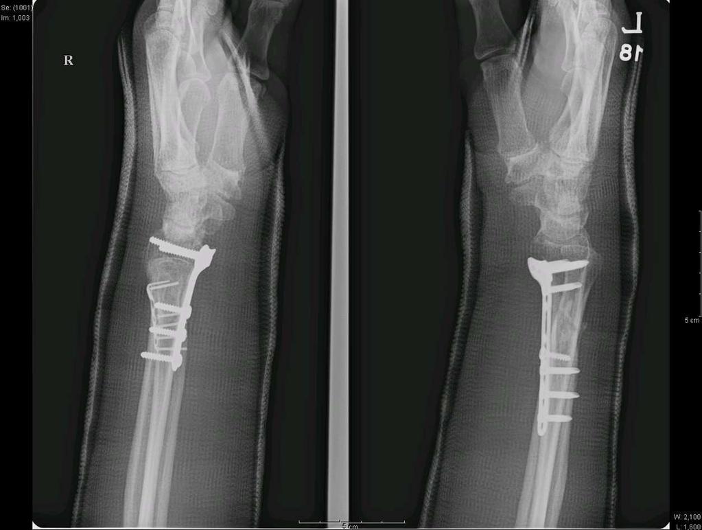 B1 fracture of distal