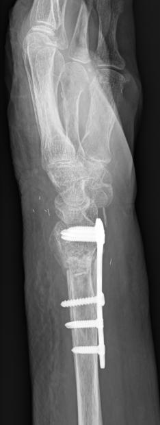 patient with AO type A3 fracture of