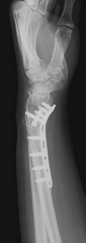 osterior and lateral wrist X-ray of 23 years old