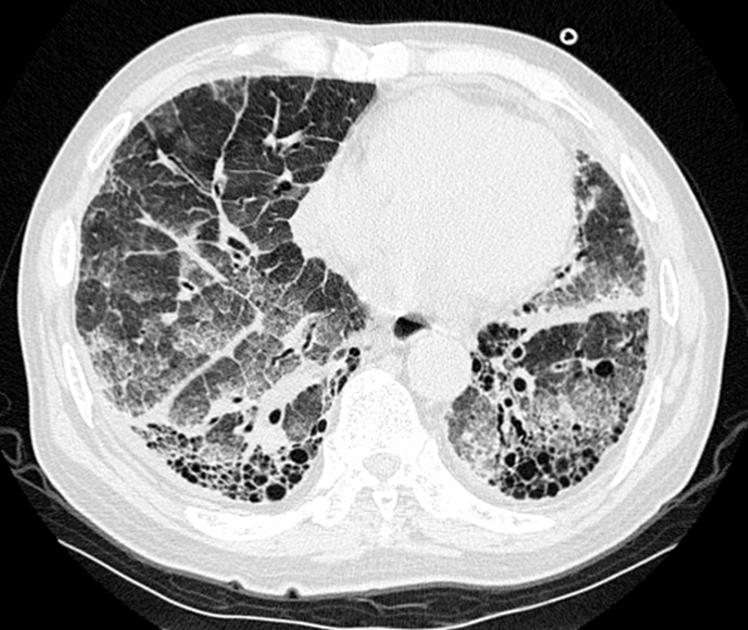 일째사망하였다. 고찰 Fig. 4. Chest computed tomography shows multifocal crazy paving pattern and interlobular septal thickening in both lung, and honeycombing in both lower lobes.