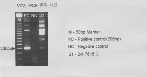 대한안과학회지제 49 권제 5 호 2008 년 Figure 3. The result of VAV-PCR in patient serum. Lane S1 demonstrating specific 200 bp amplification of the VZV band.