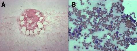 - 김경훈외 4 인 : 베체트병에동반된골수형성이상증후군 1 예 - Figure 1. Initial bone marrow findings.