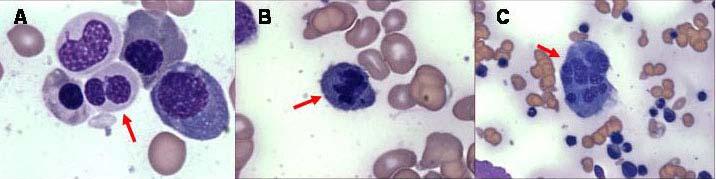 Bone marrow aspiration shows trilineage dysplasia, including (A) a pseudo- Pelger-Huet anomaly in the myeloid lineage (Wright-Giemsa stain 1000), (B) karyorrhexis in the erythroid lineage