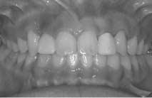 또한, #13, 23 치아가 #11, 21, 22 치아치근을심각하게흡수시키고있었다 (Fig. 2-3, 4).