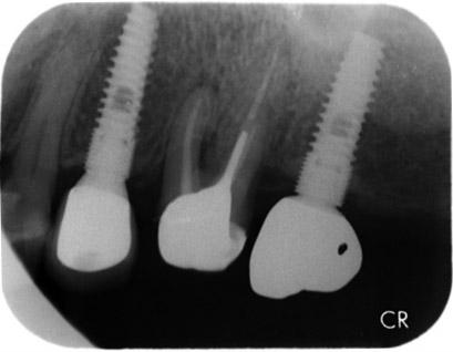 7 months after redelivery of upper left 2 nd molar crown following soldering at mesial side.